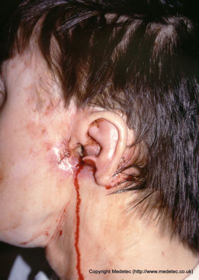 Malignant wound on face involving ear